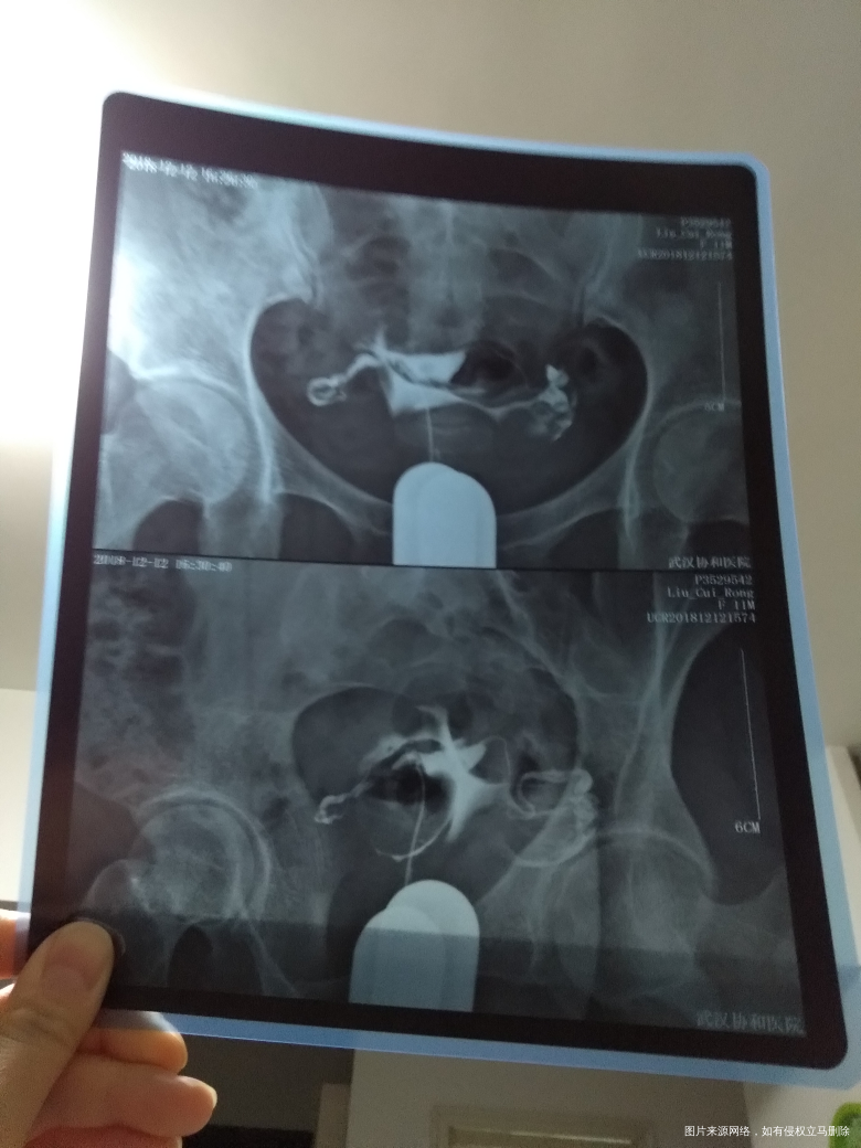 麻烦医生帮忙看看造影结果,谢谢!