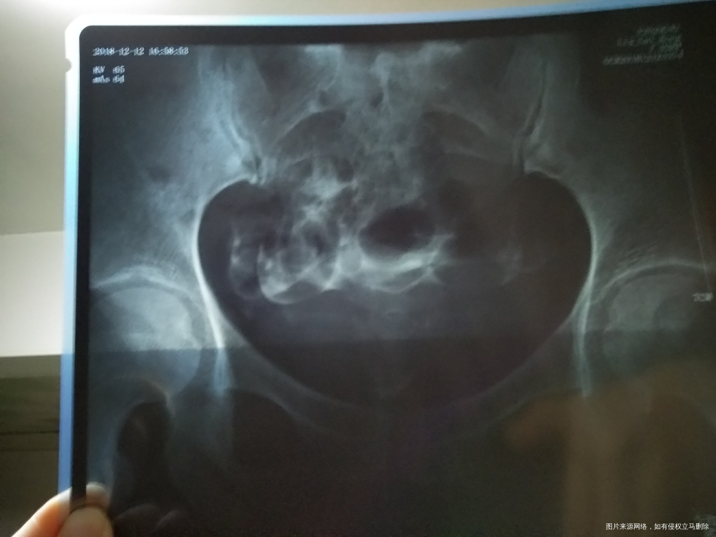 麻烦医生帮忙看看造影结果,谢谢!