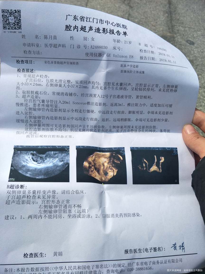 多囊,输卵管右侧通而不畅,左侧堵塞