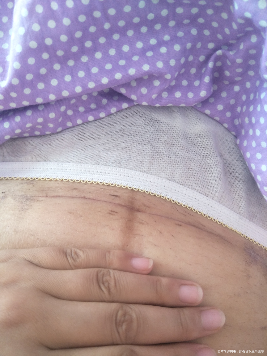 剖腹产产后22 天 麻烦医生看看刀口恢复的咋样