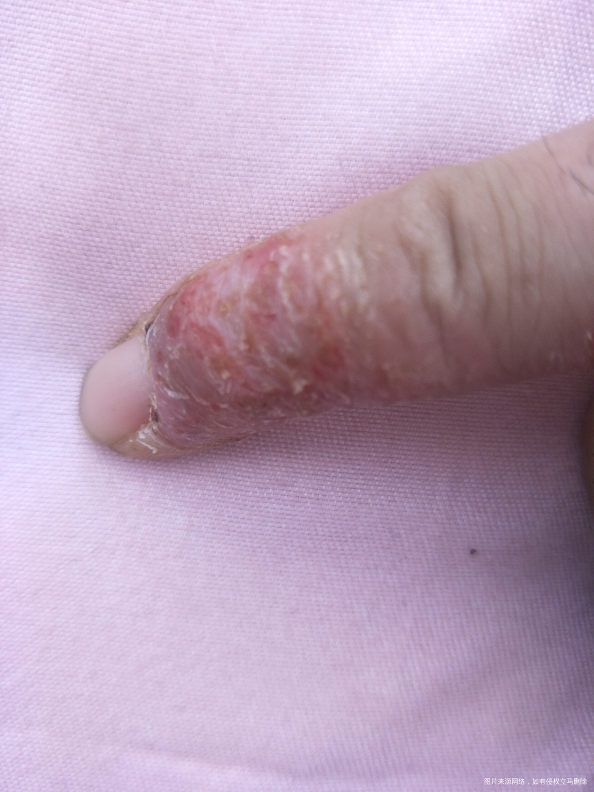 急 麻烦医生看看这个手怎么回事