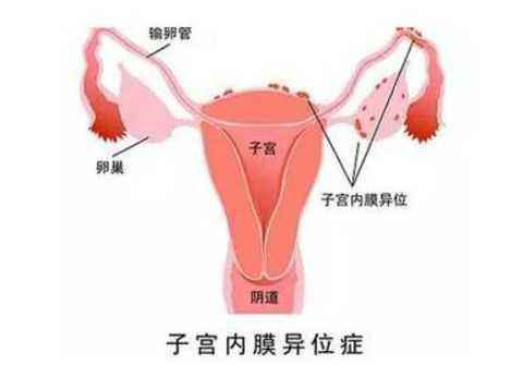 小测试，看看你需不需要警惕子宫内膜异位症！