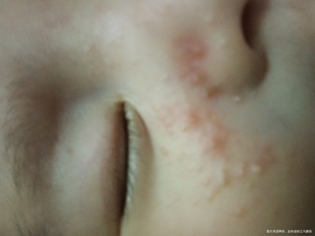 我儿子两个月了脸上急急急