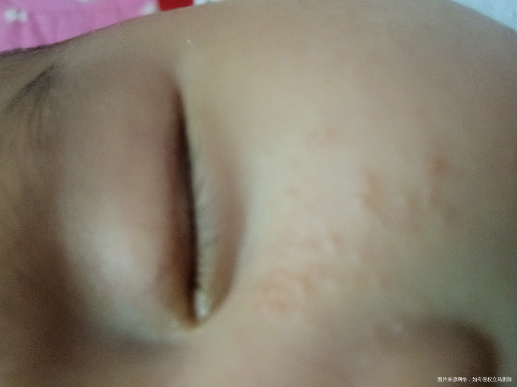 我儿子两个月了脸上急急急