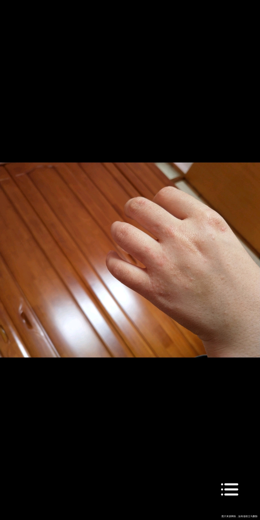 请问医生手上这个是湿疹还是