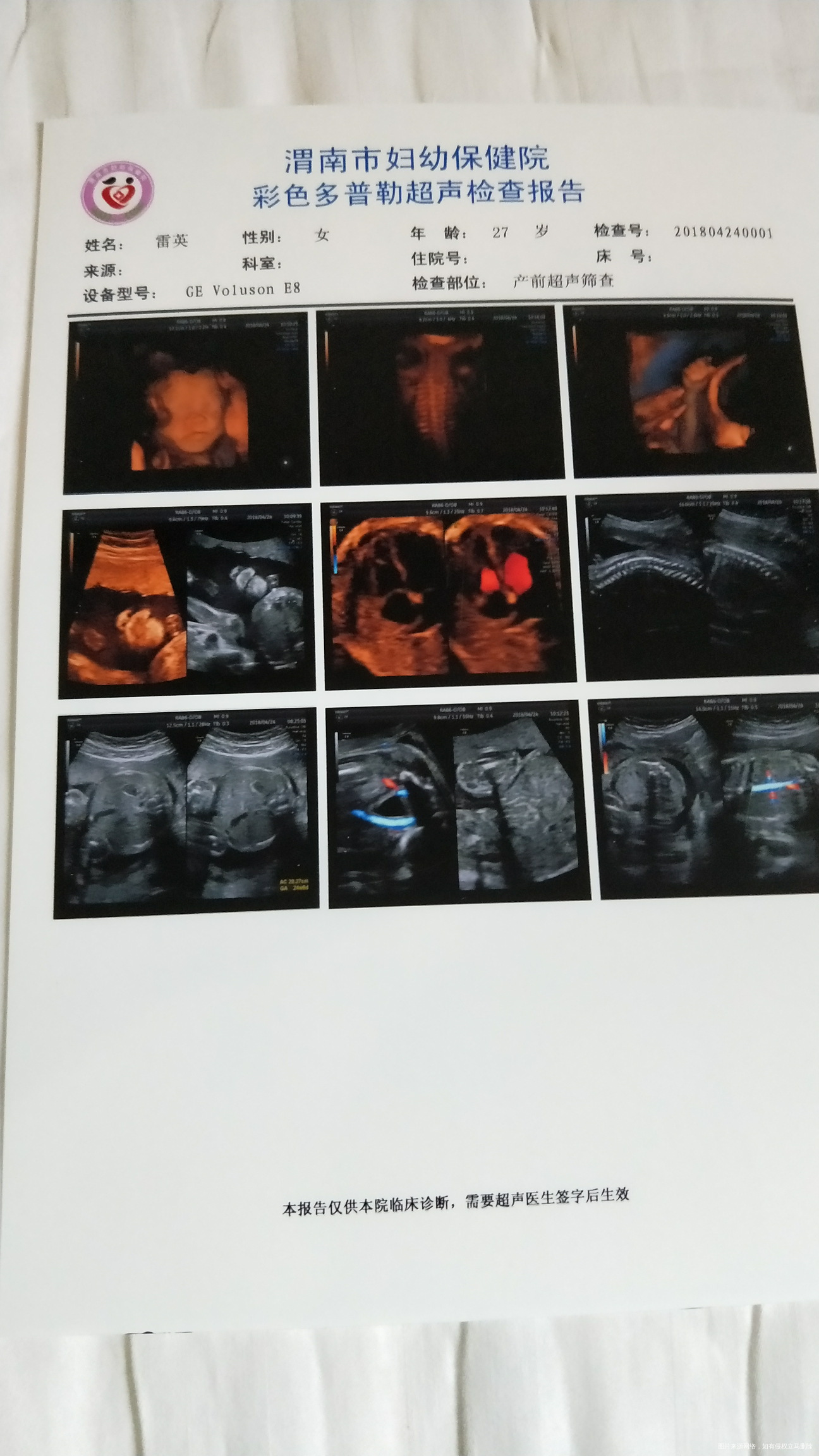 试管婴儿怀孕24周加1天