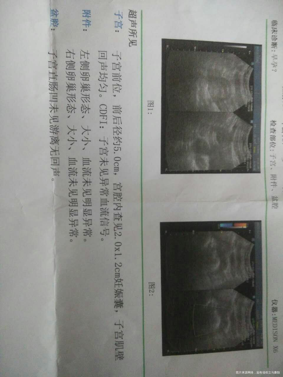 麻烦医生帮看看七周B超和血检结果