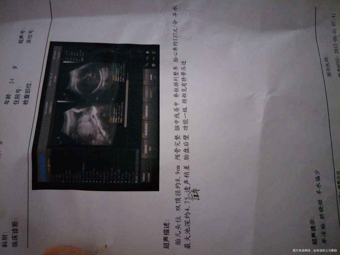 求助医生看一下是不是快要生了