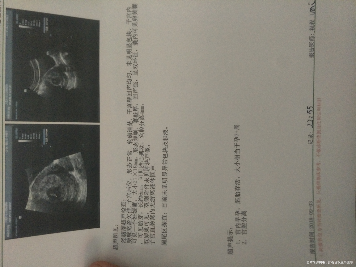 宫腔分离请医生指教一下,谢谢医生