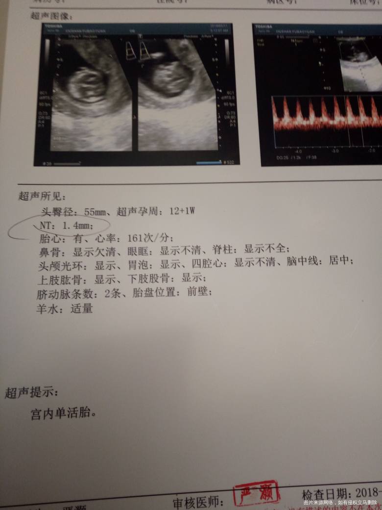 医生,帮忙看一下这个NT报告正常吗?