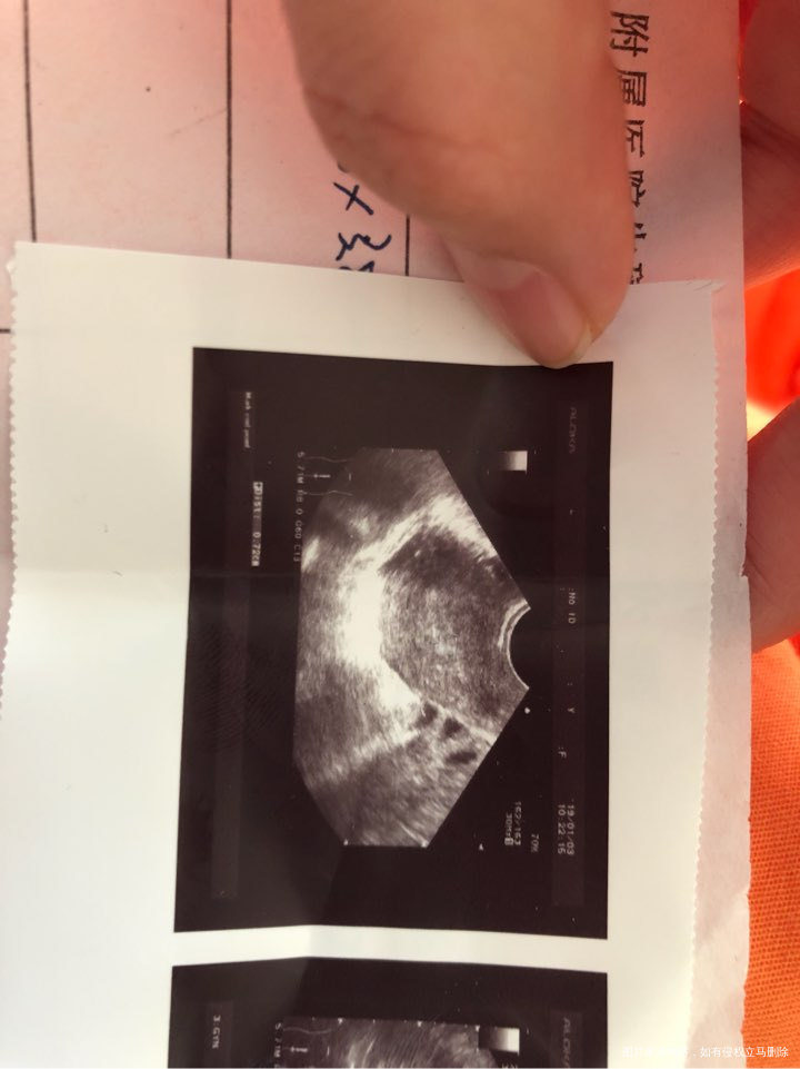 移植前是否需要做宫腔镜