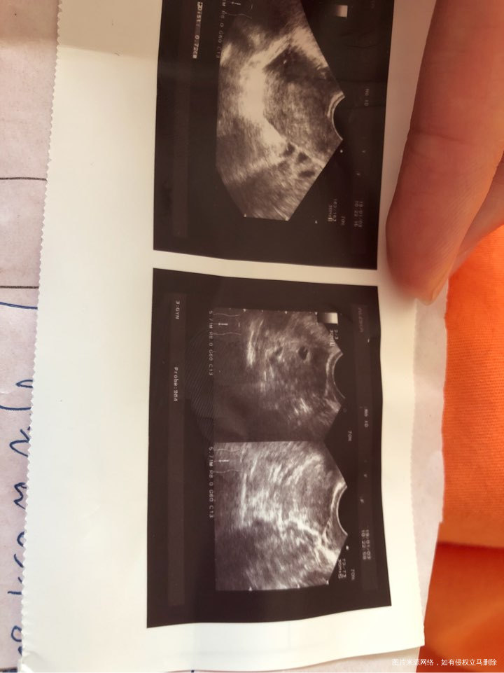 移植前是否需要做宫腔镜