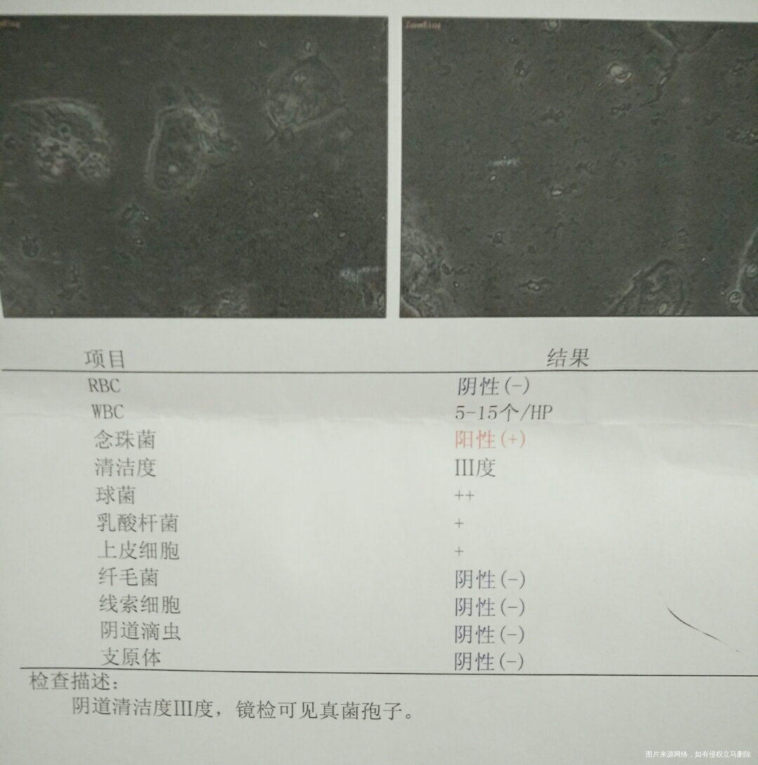 念珠菌好不了怎么做宫腔镜