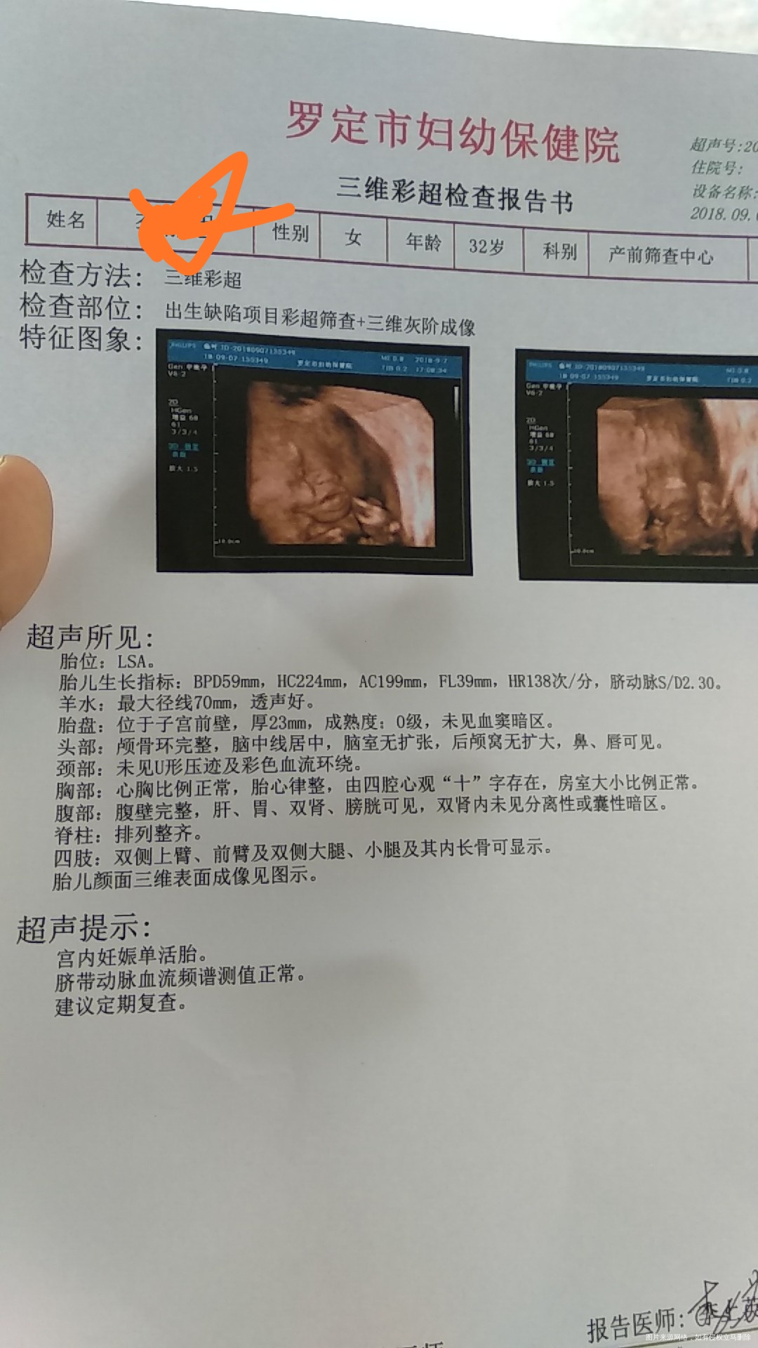 三维彩超,宝宝正常吗?医生说脚稍微短几天,严重吗