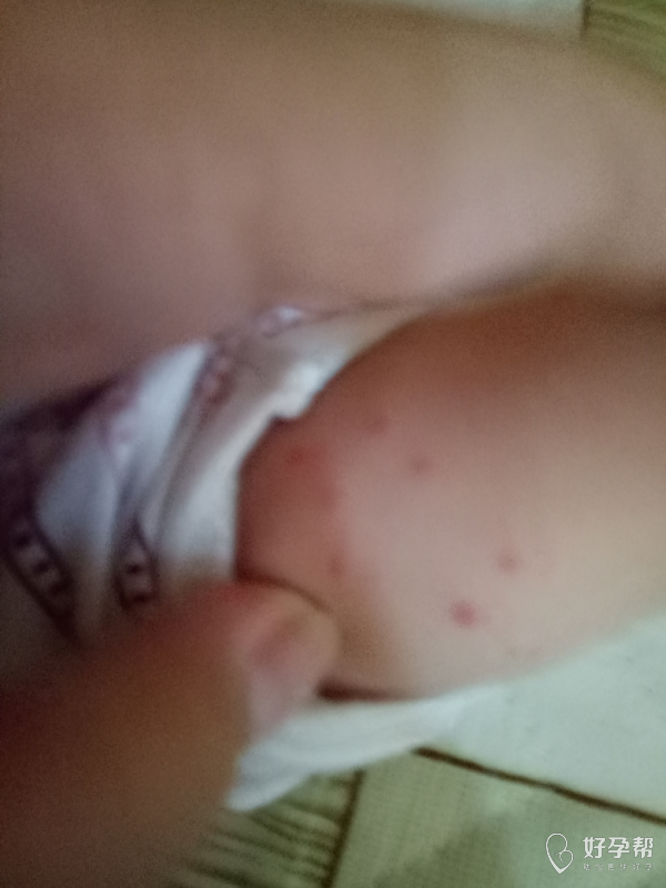宝宝被蚊子叮咬留下的红印怎样能快点消