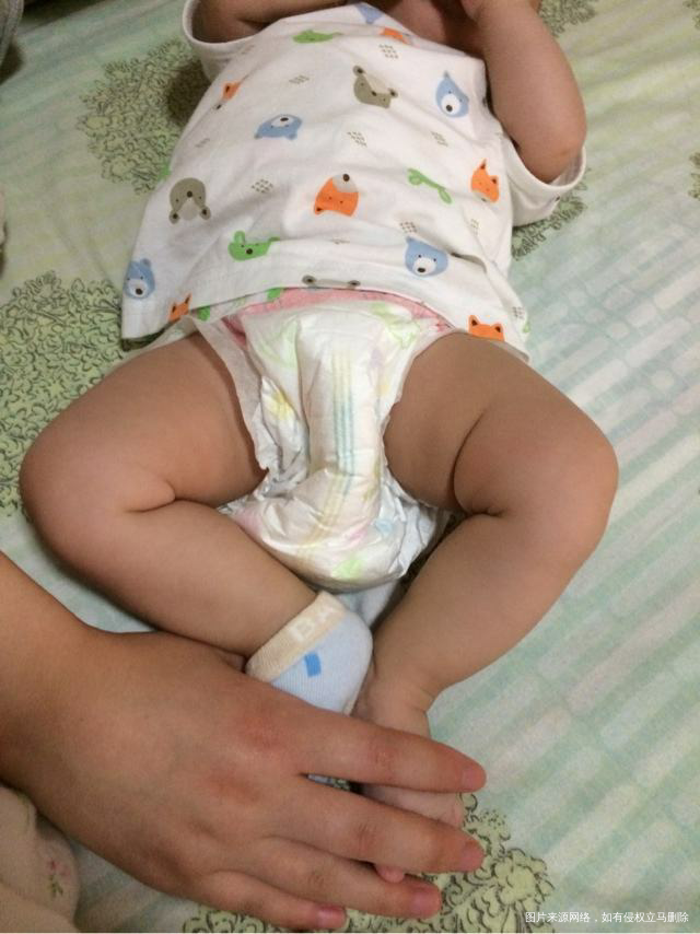 【关于腿纹】腿纹不对称很恐惧?