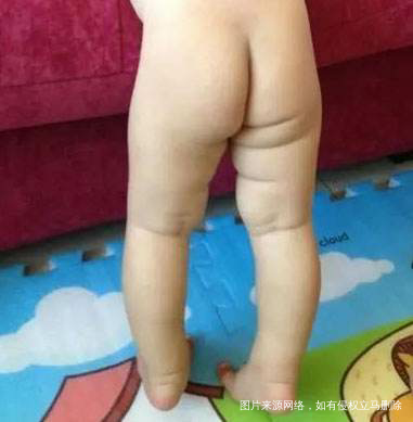 【关于腿纹】腿纹不对称很恐惧?