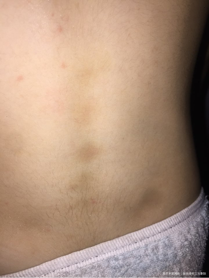 四岁半的女儿,腰椎间发瘀