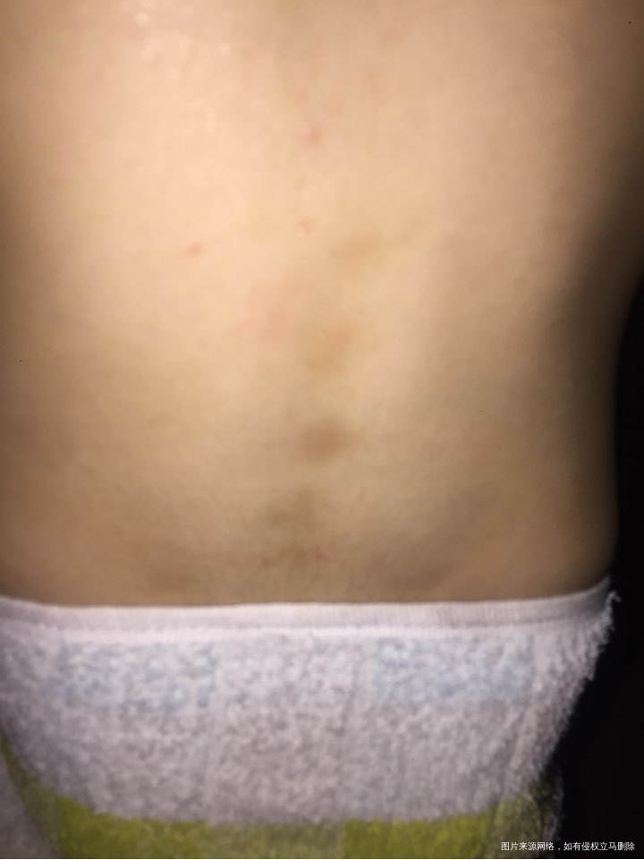 四岁半的女儿,腰椎间发瘀