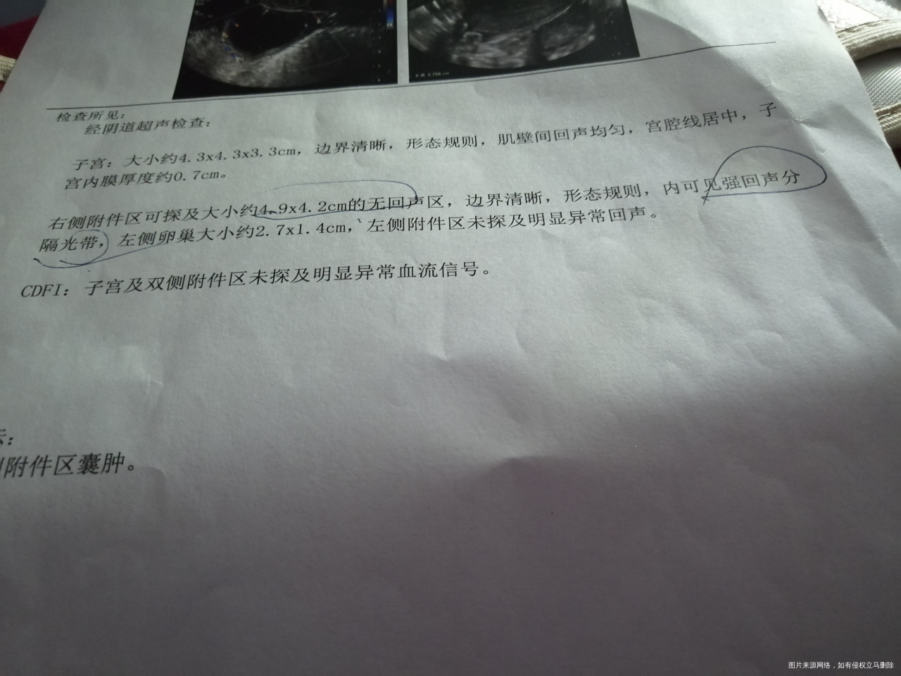 卵巢囊肿需不需要做手术?