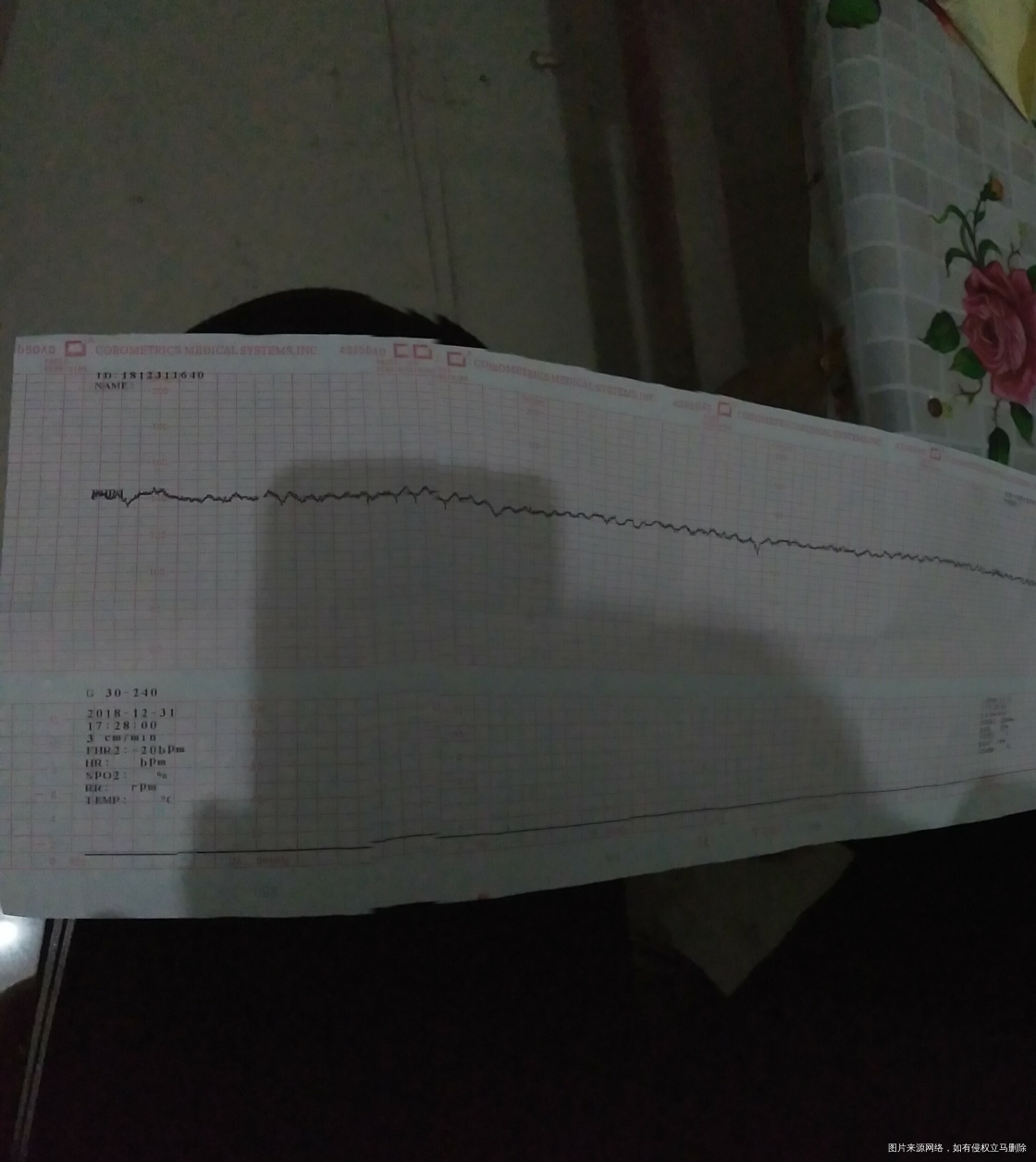 这是不是缺氧,帮忙看看,拜托了
