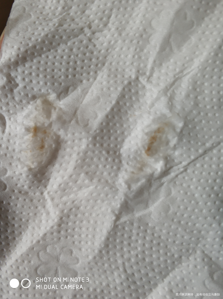 试管移植囊胚好孕18天后下面有褐色分泌物留出来,