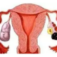 卵巢炎会影响试管婴儿的妊娠率吗