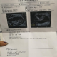 45岁泰国试管成功怀上双胞胎，坐等宝宝出生
