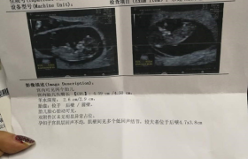 45歲泰國試管成功懷上雙胞胎，坐等寶寶出生