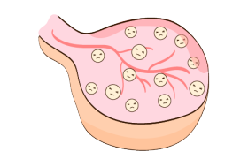 卵泡多一定是多囊卵巢综合征吗?