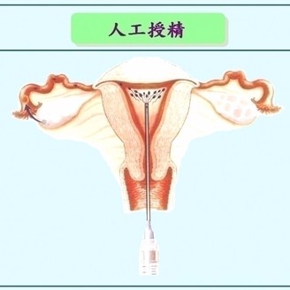 人工授精全过程