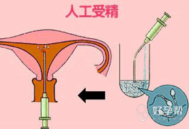 人工授精一次可以成功吗?