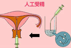 人工授精一次可以成功吗？