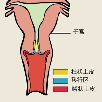 宫颈糜烂误区，治疗宫颈糜烂的误区有哪些
