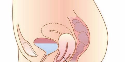 子宫腺肌症的早期症状表现