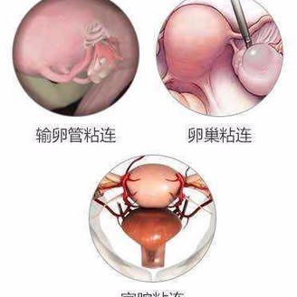 宫腔粘连的症状有哪些 并发症有哪些