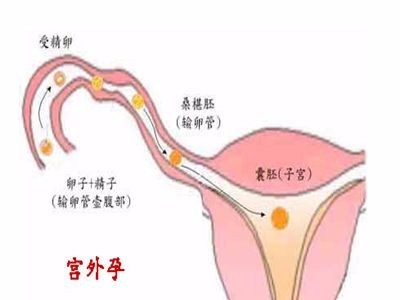 哪些女性容易得宫外孕 如何预防宫外孕