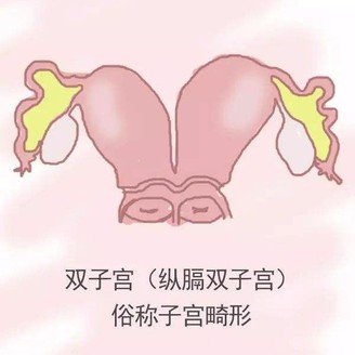 子宫畸形可以治疗吗 治疗办法是什么
