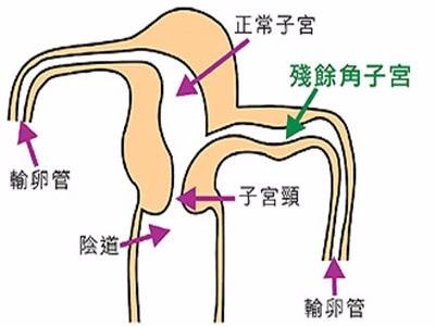 子宫畸形有几种 种类有什么