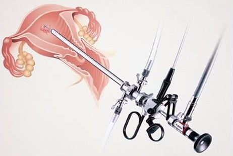 宫腔镜检查疼吗