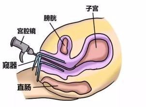 宫腔镜手术 宫腔镜手术术后注意事项