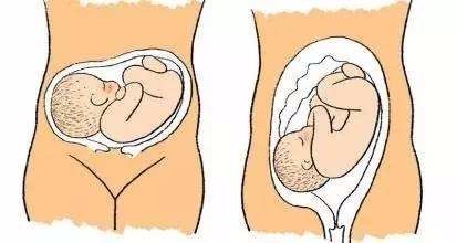 胎位不正怎样纠正 胎位不正的原因