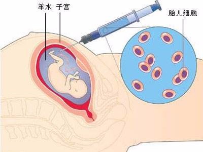 羊水穿刺怎么样做 什么时候做羊水穿刺合适