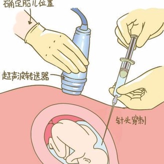 羊水过多怎么办 为什么会羊水过多
