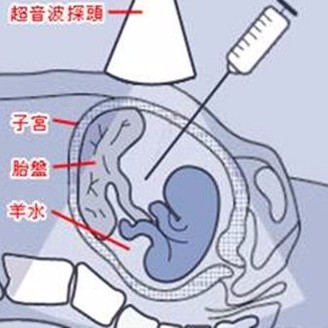 羊水破了什么感觉 羊水破了应该怎么办