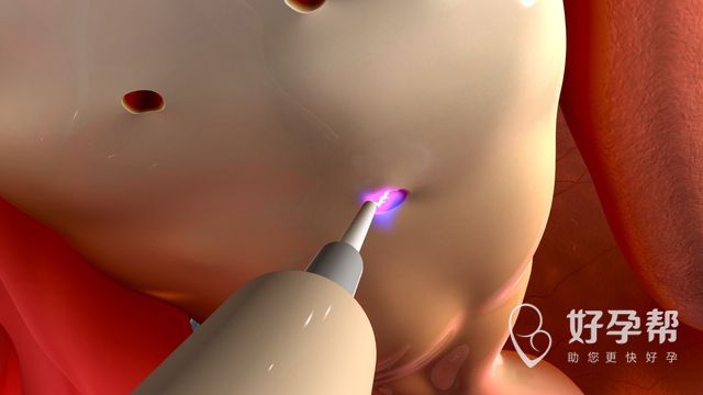 死精症能自然怀孕吗？需要怎么做？