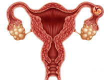 什么原因会导致宫腔粘连？宫腔粘连会影响怀孕吗？