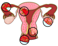盆腔积液会影响怀孕吗？盆腔积液对怀孕有什么影响？