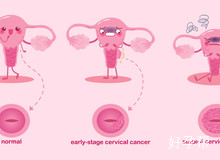 输卵管积水做什么手术？输卵管进水的手术治疗如何？