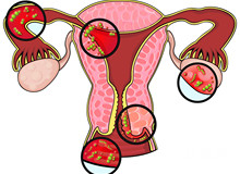 双侧输卵管间质部堵塞怎么办？为什么会出现这种情况？